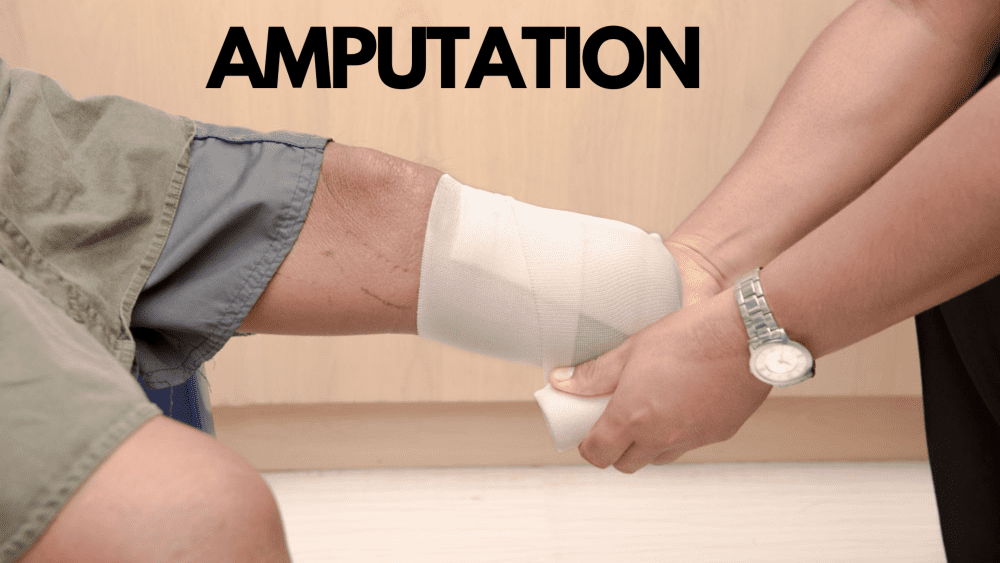 Amputation Cases